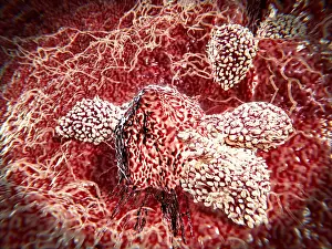Pathological Prints: Cancer cell attacked by lymphocytes