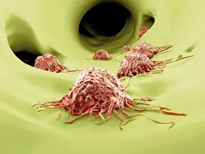 Pathological Prints: Cancer cells, artwork