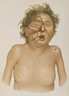 Atlas Prints: Carbon Monoxide Poisoning, Agonal Injuries, 1898