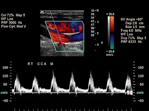 System Prints: Carotid Duplex Ultrasound Exam