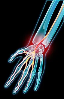 Hand Prints: Carpal Tunnel Syndrome, Illustration