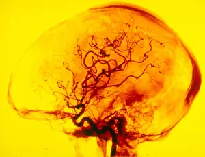 Internal Prints: Cerebral Angiogram