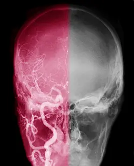Cerebrum Prints: Cerebral Angiogram
