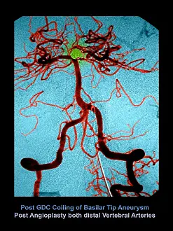 : Cerebral Angiogram of Aneurysm, Brain Medical Scan of Blood Flow
