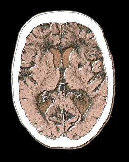 Cerebral CAT scan showing atrophy