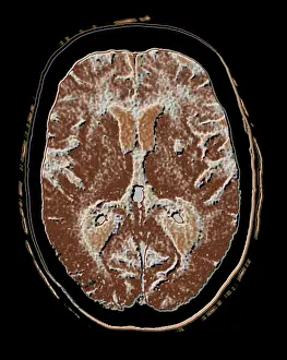 Cerebral CAT scan showing atrophy