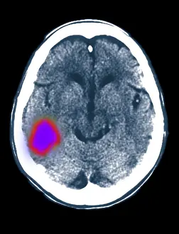 Bleeding Prints: Cerebral CT scan showing stroke