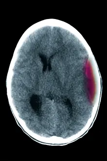 Diagnosis Prints: Cerebral CT showing epidural hematoma