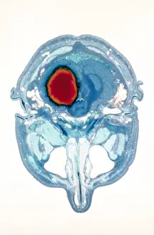 Cerebral Prints: Cerebral hemorrhage