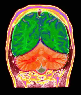 Magnetic Prints: Cerebral MRI