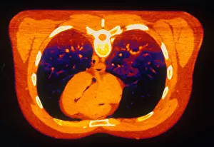 Project Prints: Chest & Heart, CT Scan