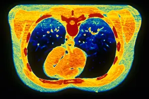 Project Prints: Chest & Heart, CT Scan
