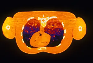 Project Prints: Chest & Heart, CT Scan