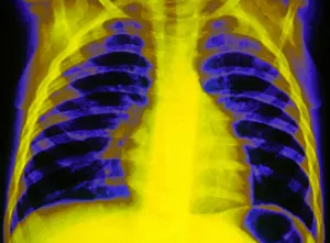 Chest Prints: Chest X-ray