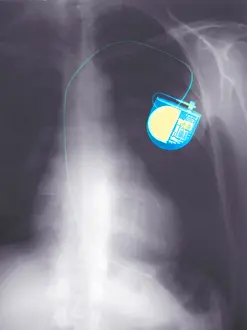 Radiographs Prints: Chest x-ray of a pacemaker