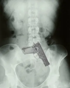 Weapon Prints: Chest x-ray showing hidden gun