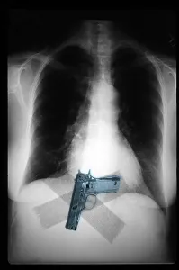 Weapon Prints: Chest x-ray showing hidden gun