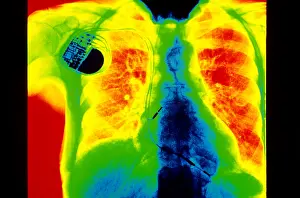2005 Prints: Chest X-Ray Showing Pacemaker