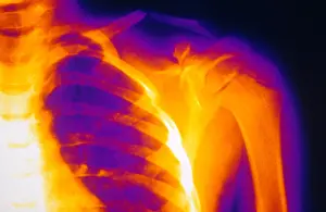 Child Prints: Child's Fractured Clavicle, X-ray