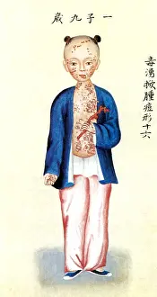 Watercolours Prints: Chinese Smallpox Victim