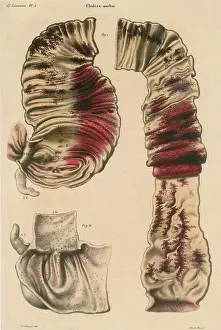 Robert Prints: Cholera Infected Intestines, 1808