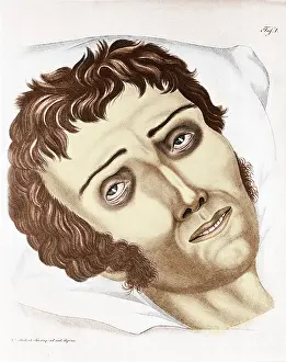 1830s Prints: Cholera Victim, 1831