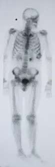 Nuclear Prints: Chondrosarcoma