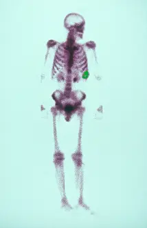 Nuclear Prints: Chondrosarcoma