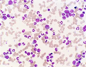 Pathological Prints: Chronic Granulocytic Leukemia Under the Microscope