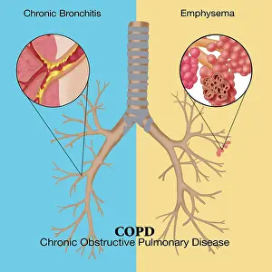 Flow Prints: Chronic Obstructive Pulmonary Disease (COPD)