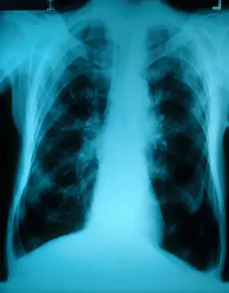 Condition Prints: Chronic Obstructive Pulmonary Disease (X-ray)