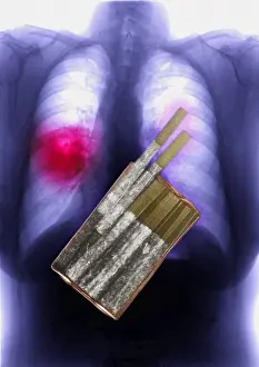 Concept Prints: Cigarettes and Lung Cancer