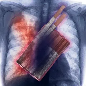 Concept Prints: Cigarettes and Lung Cancer