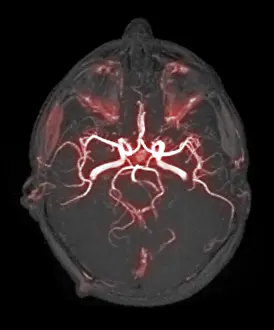 Cerebrum Prints: Circle of Willis, Angiogram