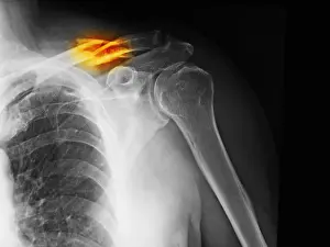 Body Prints: Clavicle Fracture