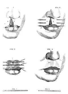 Benjamin Prints: Cleft Lip Surgery, 1791
