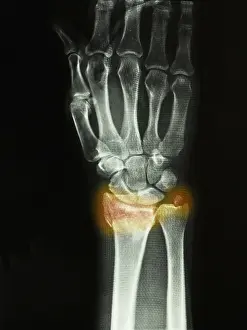 Diagnosis Prints: Colles Fracture
