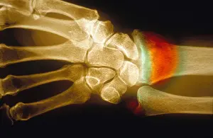 Test Prints: Colles Fracture, X-ray