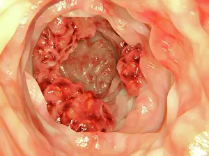 Pathological Prints: Colon cancer, artwork