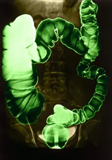 Intestines Prints: Colon Examination, Barium Enema