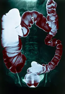 Diagnosis Prints: Colon Examination, Barium Enema