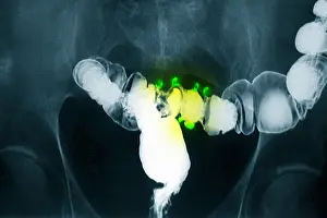 Intestines Prints: Colon x-ray with barium contrast