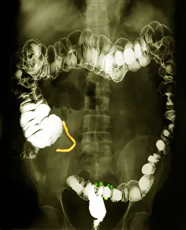 2003 Prints: Colon x-ray with barium contrast