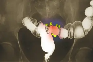 Body Prints: Colon x-ray with barium contrast