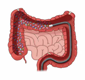 Intestines Prints: Colonoscopy Administering a Fecal Microbiota Transplantation (FMT)
