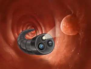 Spirals Prints: Colonoscopy with Polyps