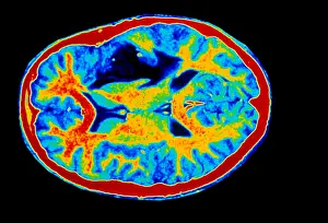 2004 Prints: Colored MRI scan of brain cancer