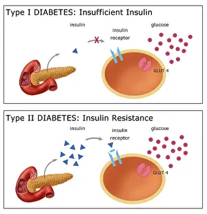 Receptor Prints: Comparative diagram of type I diabetes and type II diabetes