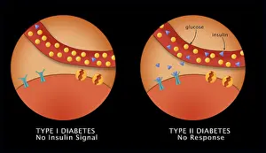 Compare Prints: Comparative diagram of type I diabetes and type II diabetes