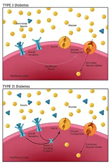 Type Prints: Comparative diagram of type I diabetes and type II diabetes